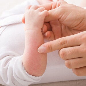 parent pointing at a rash on baby who is wearing white bodysuit arm 